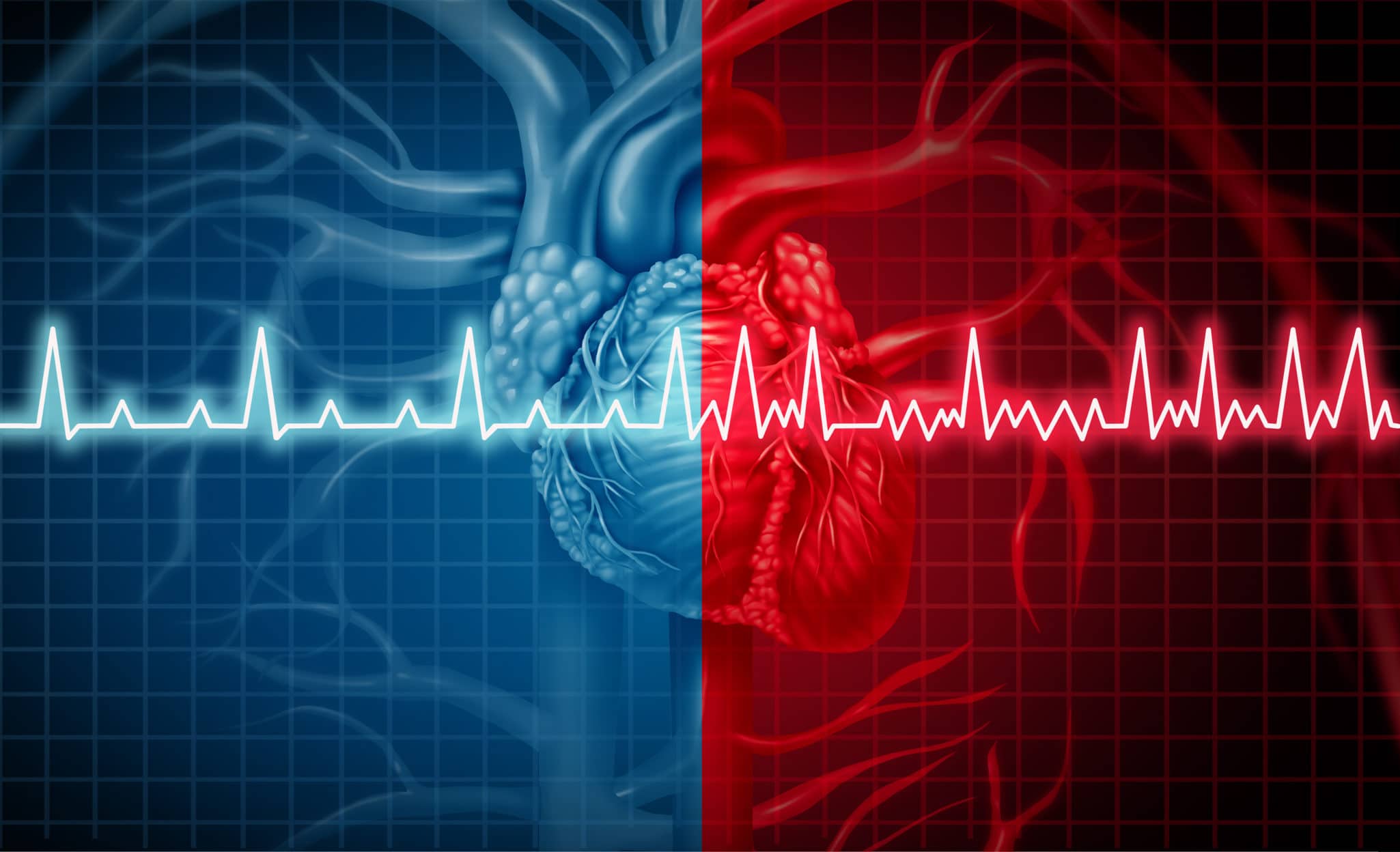 Atrial Fibrillation