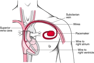 pacemaker